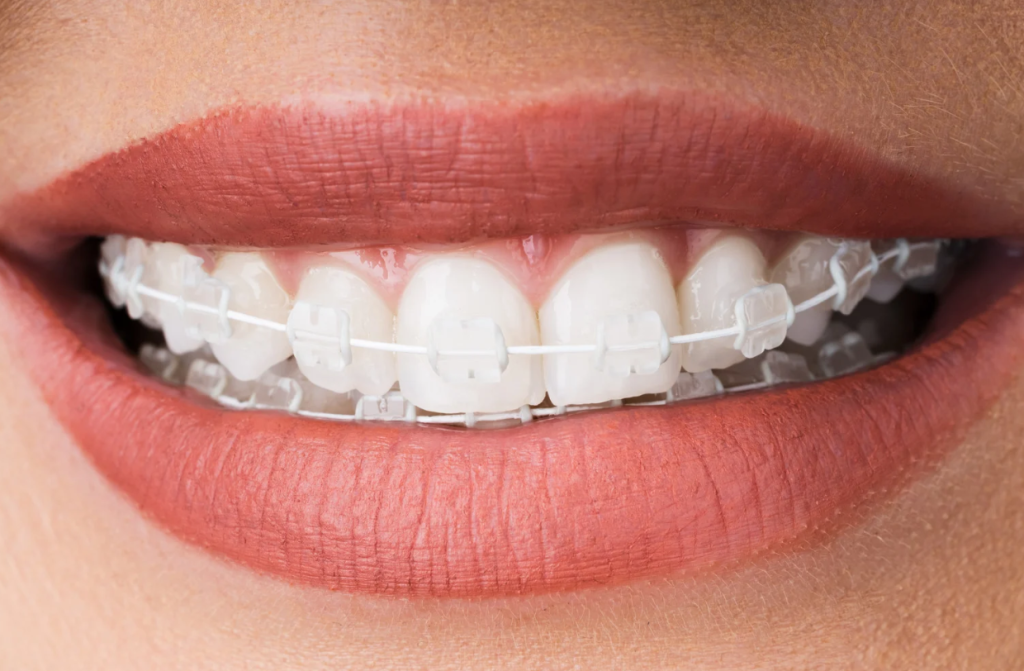 Clear Ceramic Braces