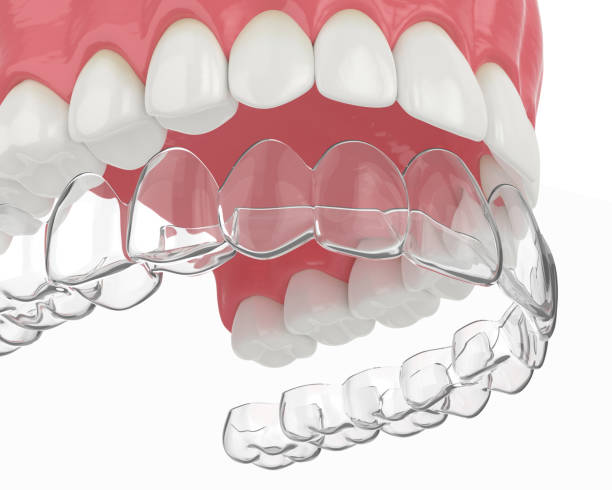 3d render of upper jaw with invisalign removable retainer over white background